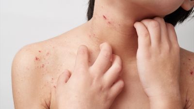 軟水でアトピーや肌トラブルの改善